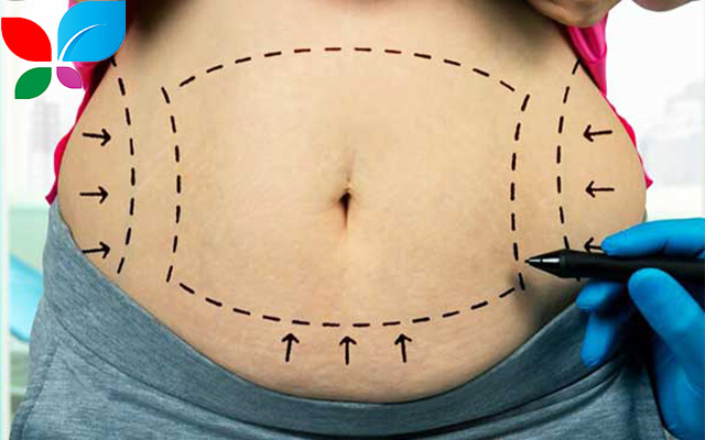 شفط الدهون في سوريا 2025: دليلك الشامل لجسم أحلامك بأفضل التقنيات العالمية