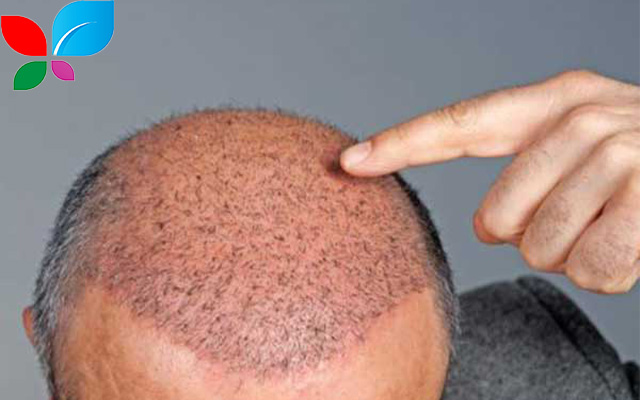 زراعة الشعر في سوريا 2025: دليلك الشامل لاستعادة الثقة بأفضل التقنيات وأنسب الأسعار